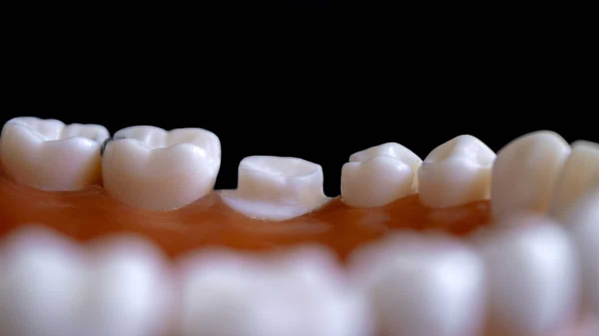 Wisdom tooth infection turns deadly for 23-year-old girl. Here's how Wisdom tooth infection turns deadly for 23-year-old girl. Here's how