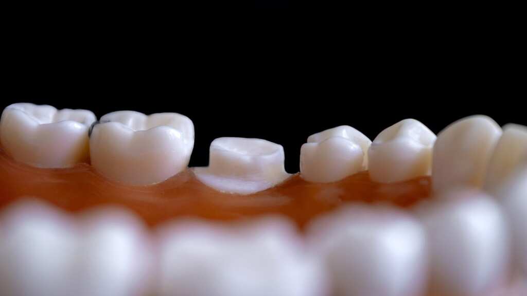 Wisdom tooth infection turns deadly for 23-year-old girl. Here's how