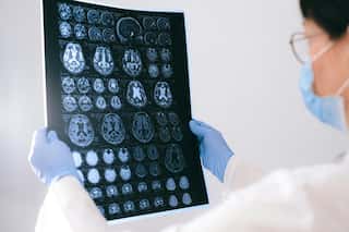 India: Man with no prior health issues suffers brain haemorrhage after loud DJ music exposure