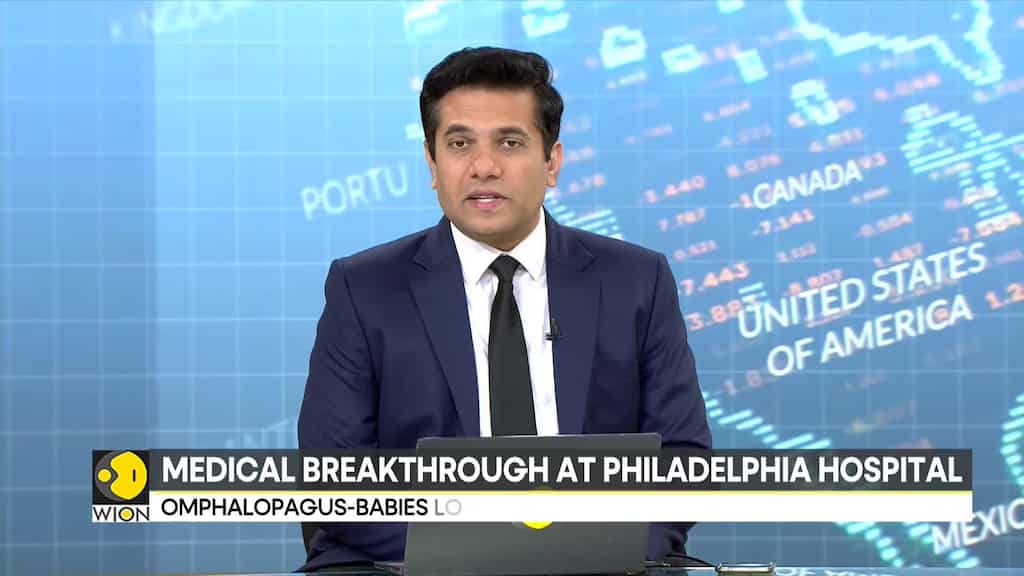 Conjoined Twins Successfully Separated After 8-Hour Long Surgery