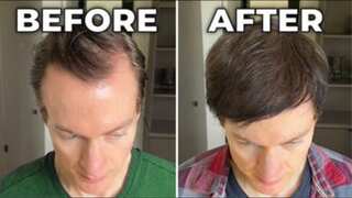 Millionaire Bryan Johnson claims to ‘reverse his hair loss and greying by 70 per cent’