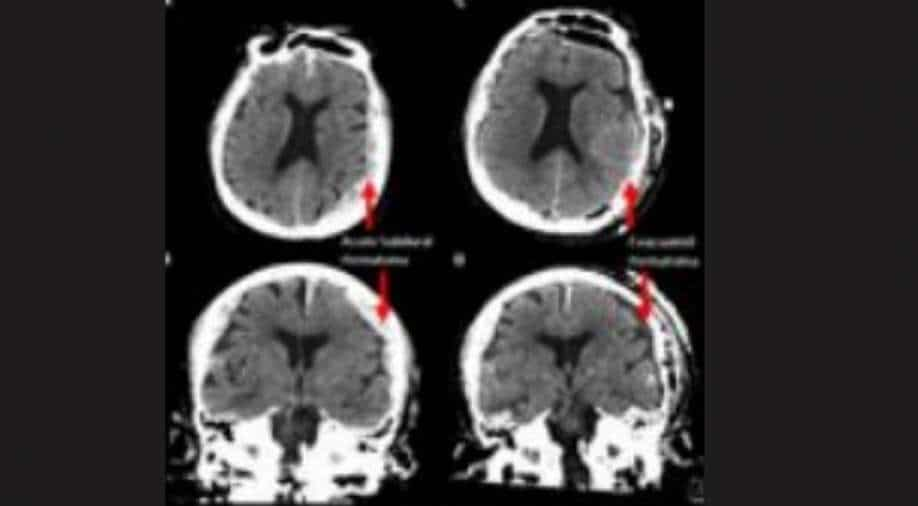 First ever scan of dying human brain shows astounding results, Science News  | wionews.com