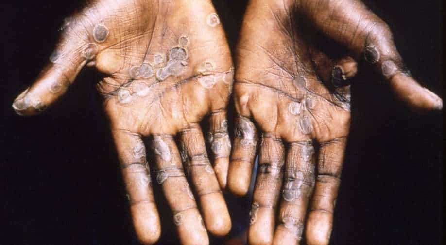 After Europe & Europe, monkeypox spreads to Israel - Vimarsana News