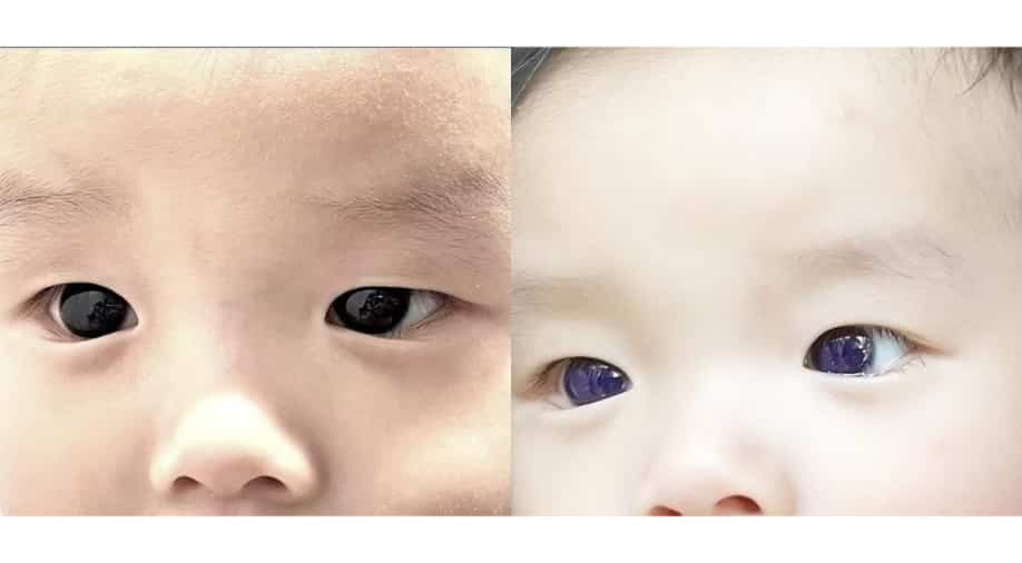 Infant's eye colour changes from dark brown to bright blue after COVID